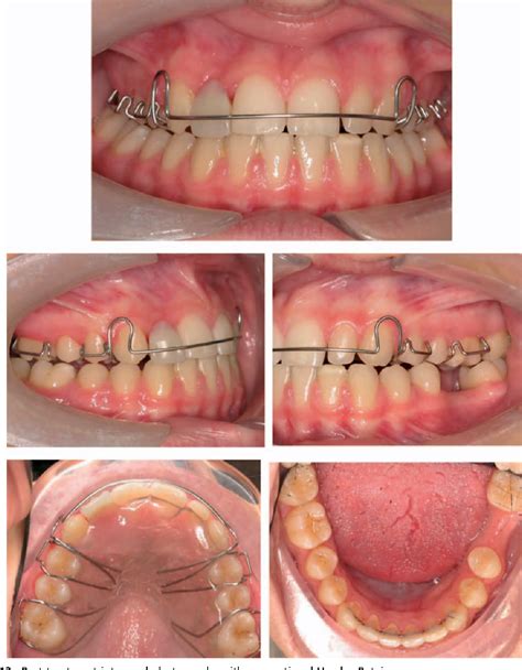 Spring Retainer Before And After