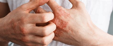 Eczema – types, symptoms, and treatment | Eucerin