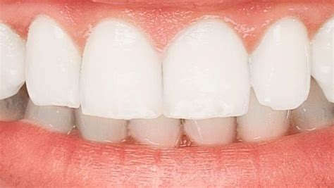 Blancorexia: la obsesión por tener unos dientes más blancos - Grup Dr. Bladé