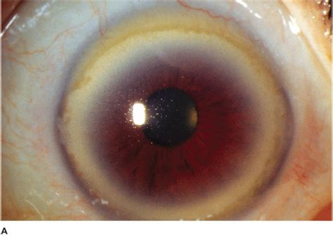 Corneal Degeneration Treatment