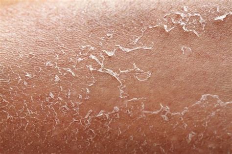 Premium Photo | Details of a woman's dry skin Exfoliation after ...