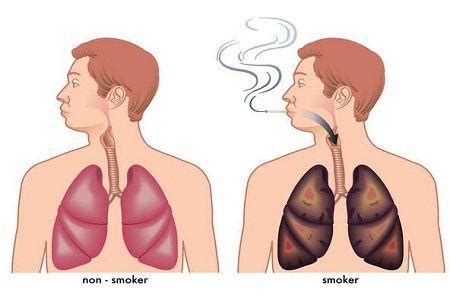 Smokers Cough – Respicare India