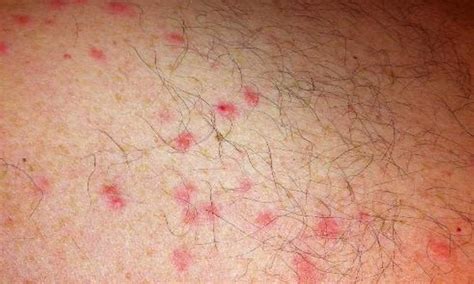 What Does Scabies Rash Look Like