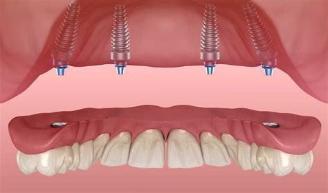 All-on-X Dental Implants Explained: Your Ultimate Guide