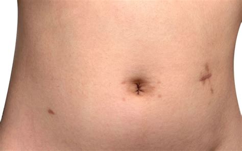 Belly Button Yeast Infection – How To Get Rid Of It?