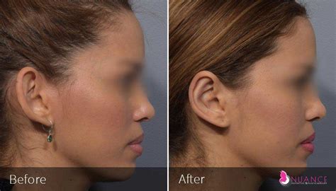 Ear Reshaping Surgery (Otoplasty) in Las Vegas, NV | Nuance