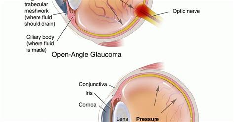 Glaucoma a leading cause of blindness