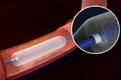 BD's Lutonix 018 DCB approved by FDA to treat SFA disease