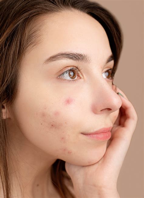 The Truth About Acne - The Dermatology Clinic