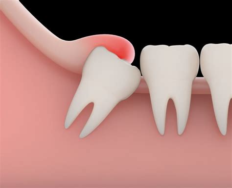 Symptoms Of Impacted Wisdom Tooth | Shinagawa Orthodontics