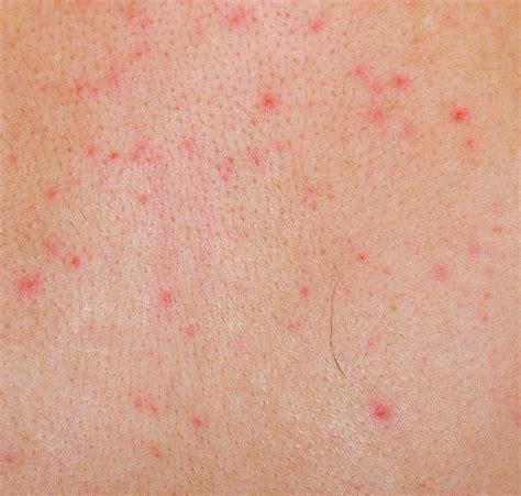 What Are The Most Common Causes Of A Petechial Rash | Images and Photos ...