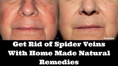 Pin by julie wheat on BEAUTY TIPS | Spider veins, Get rid of spider veins, Water retention remedies