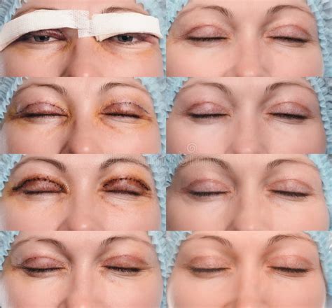 Blepharoplasty of the Upper Eyelid. Stock Image - Image of close, care: 89729957