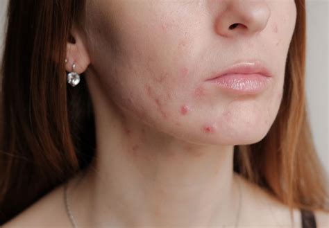 Acne after laser hair removal and its treatment | پرنیان