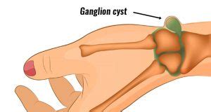 Ganglion cyst - Symptoms, Causes, Treatment and Surgery