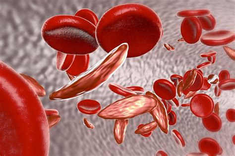 Sickle cell patients with vitamin D deficiency prone to more ED visits, longer stays | MDedge ...