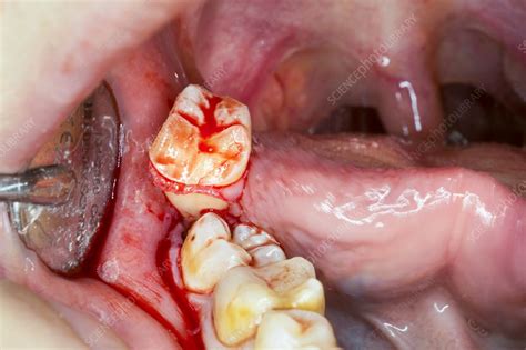 Molar teeth - lphac