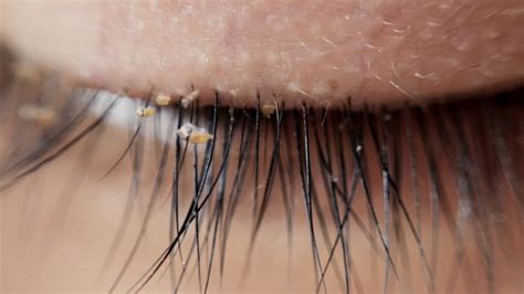 Doctors warn about lash lice becoming more common in eyelash extensions - ABC11 Raleigh-Durham