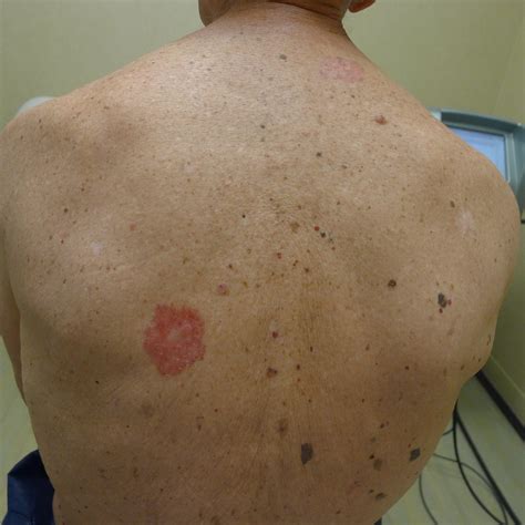 Signs Of Skin Cancer On Back at williambparker blog