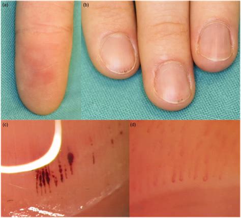 Diagnosis at your fingertips: splinters and microemboli – is it SLE? - C T Berger, T Baldi, M ...