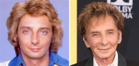 Barry Manilow Before and After Plastic Surgery