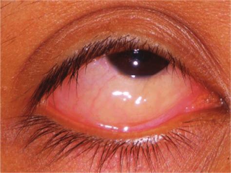 Swollen Sclera Eye