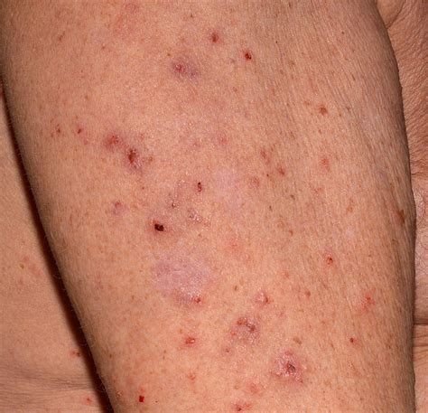 Scabies — Gateway Dermatology