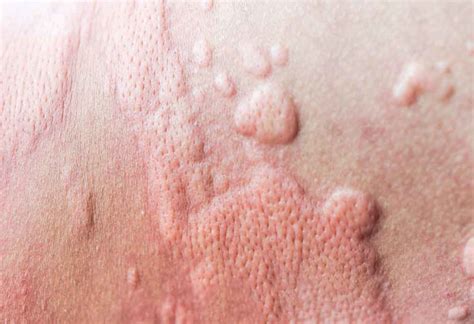 PUPPP Rash While Pregnant: Reasons, Signs & Treatment