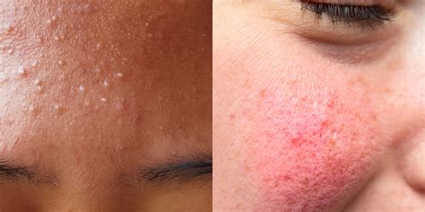 Do I have acne or rosacea?