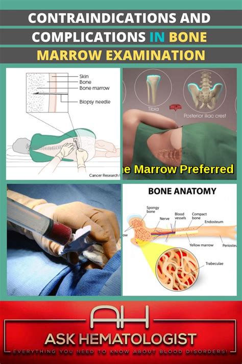 Bone Marrow Examination | Ask Hematologist | Understand Hematology in ...