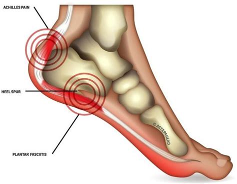 Shockwave Therapy for Chronic Heel Pain - Relinque