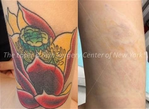 Tattoo Removal Service New York, NY | Laser Center