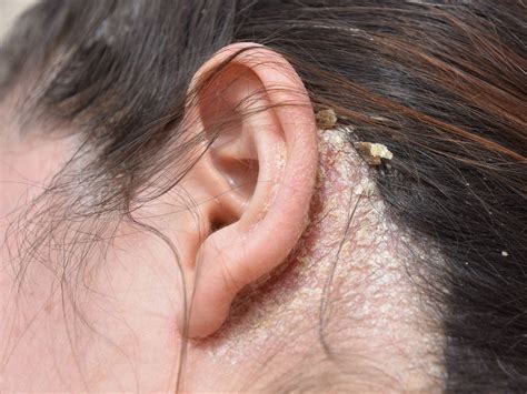 Are Fungal Infections on the Scalp Dangerous? | Balmonds