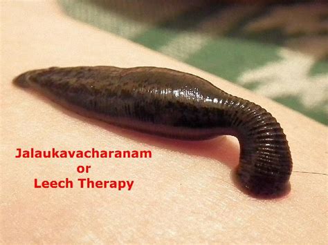 Leech Therapy in Delhi India