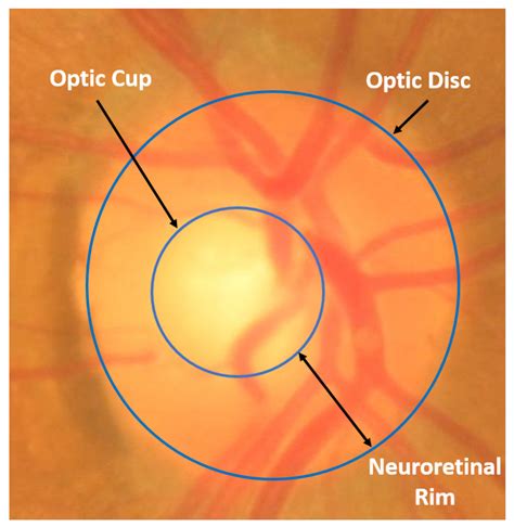 Optic Disc