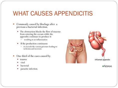 PPT - APPENDICITIS PowerPoint Presentation, free download - ID:2176545