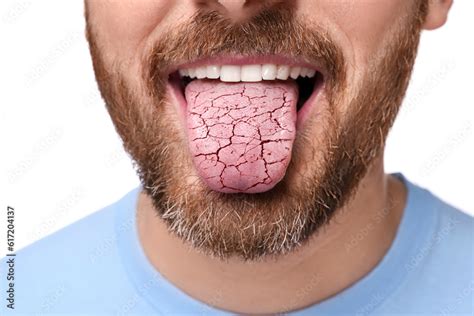 Dry mouth symptom. Man showing dehydrated tongue on white background ...