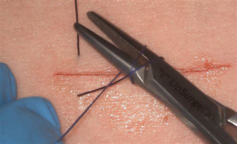 Simple Interrupted Suture | UpSurgeOn