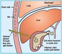 The Upper Gastrointestinal Tract - Upper abdominal pain: Gall bladder - Zanmeel.com