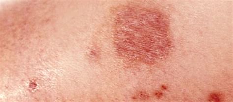 Brown Recluse Spider Bite: Stages, Symptoms and Treatment