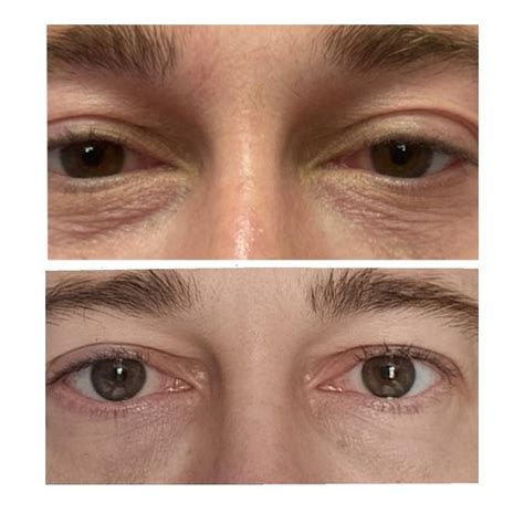 LUMI EYES treatments at Suzanne's Beauty Clinic in Coventry