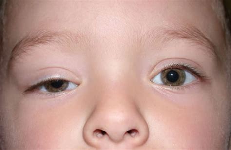 Ptosis (Drooping Eyelids) - Fort Worth Eye Associates