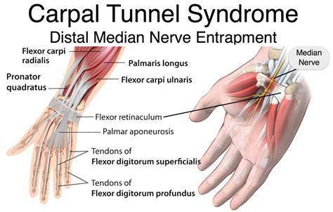 Carpal Tunnel Syndrome - Causes, Treatment, Splint & Surgery