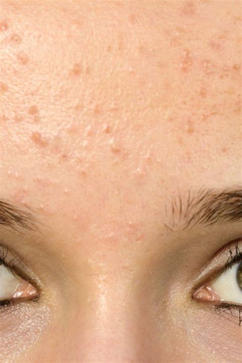 Forehead acne and pimples: Causes, treatment, and prevention