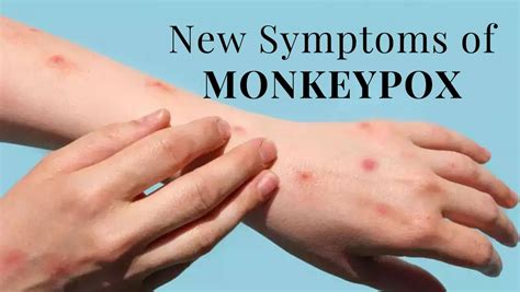 New Symptoms of Monkeypox: 3 Severe Symptoms To Watch Out For | TheHealthSite.com