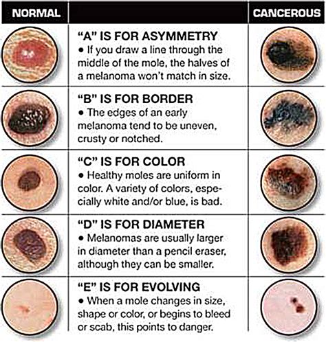 Skin Cancer and My Feet, What do I need to Know