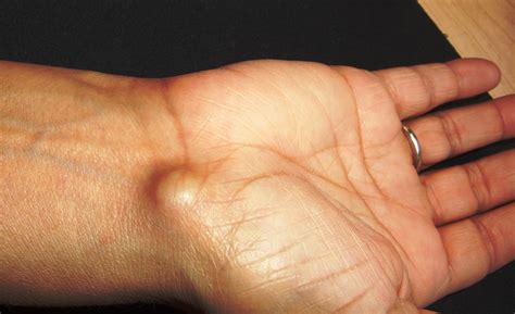 Ganglion Cyst | Wikipedia: The exact cause of the formation … | Flickr