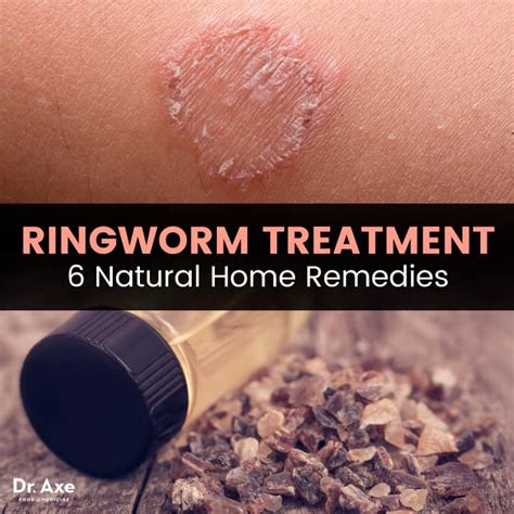 Ringworm Skin Rash Treatment | Hot Sex Picture
