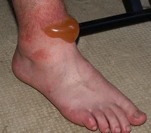 Blisters On Feet & Toes: Causes & Treatment - Foot Pain Explored