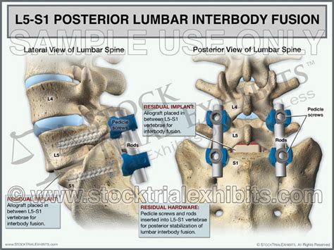 L5-S1 Posterior Lumbar Interbody Fusion (PLIF) – Stock Trial Exhibits